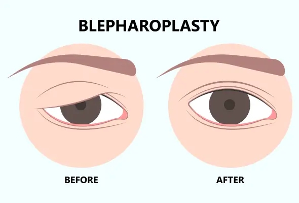 How to Choose the Right Blepharoplasty
