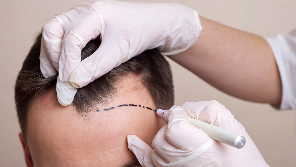Hair Transplant in Singapore: Rebuilding Confidence, One Follicle at a Time