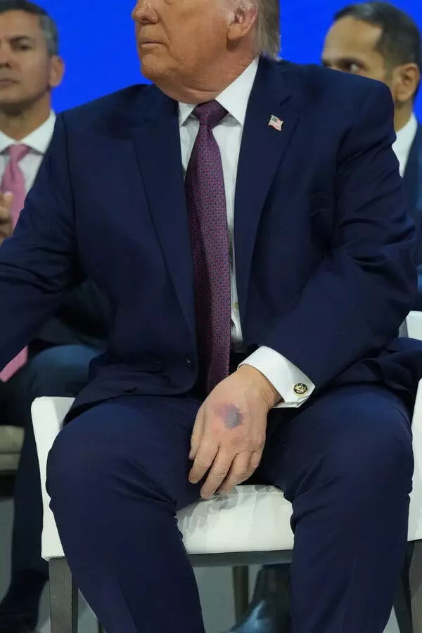 Trump Explains Hand Bruise Amid Health Speculation